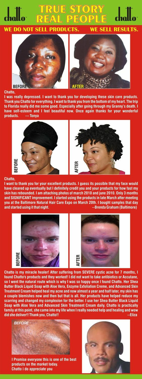 Acne | Pimples