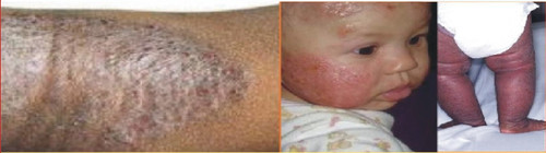 Our proprietary formula addresses scaly, itchy skin. We blend ingredients well-known for centuries to soothe broken, irritated skin and support healthy skin cell rejuvenation.

This nutrient rich cream with vitamin A, antioxidants, and essential oils moisturizes dry-flaky skin, scaly skin and clears serious skin problems. The versatile active ingredients such as Oatmeal, Shea Butter, and Aloe Vera help moisturizing and rejuvenation. The product is non-greasy, gentle, highly effective and suitable for small children.

Nothing comes close to the ancient healing properties of Chatto's unsurpassed products.