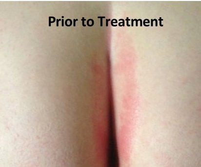 Ecoleaf Butt Cream Symptomatic Rash Relief | Made In The Usa With Organic Plant Extracts & Oils | Great For Diaper Rashes, Chafing, Burns, Cuts, Itching | Designed For Babies, Kids, Adults, Athletes