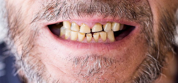 Tooth Abrasion: Causes and Treatment - Pro Teeth Guard