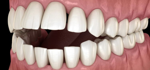 Can a Night Guard Cause an Open Bite?