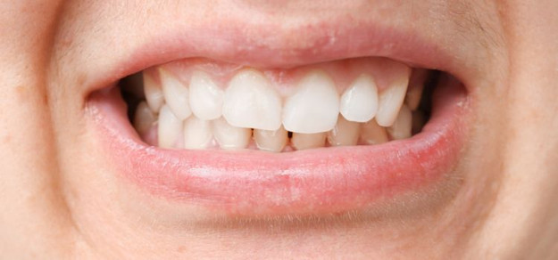 Can a Misaligned Bite Cause Bruxism?