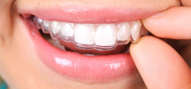Essix Retainer