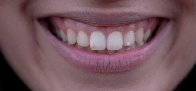 Losing Enamel on Front Teeth