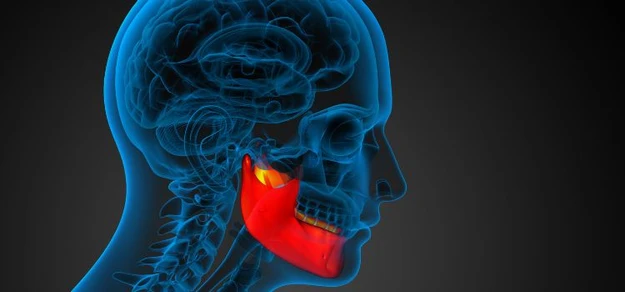 Multiple Sclerosis Teeth Grinding