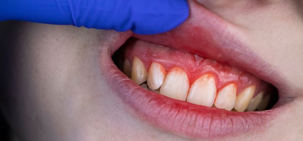 Swollen Gums from Teeth Grinding? Causes & Relief