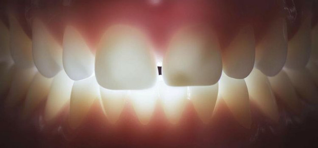 Tooth Gaps: Causes, Risks, and Treatment Options