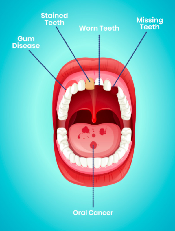 Alcohol And Oral Health