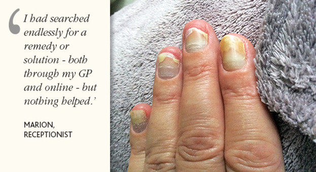 Case Study: 'Miracle Worker' for Nails