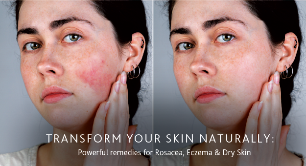  Transform Your Skin Naturally: Powerful Remedies for Rosacea, Eczema and Dry Skin