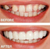 Sweet Simle instant Veneers 1039