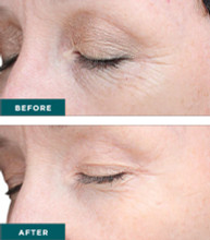 VI Peel Advanced Chemical Peel
