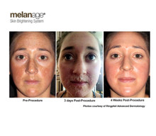 Melanage Peel