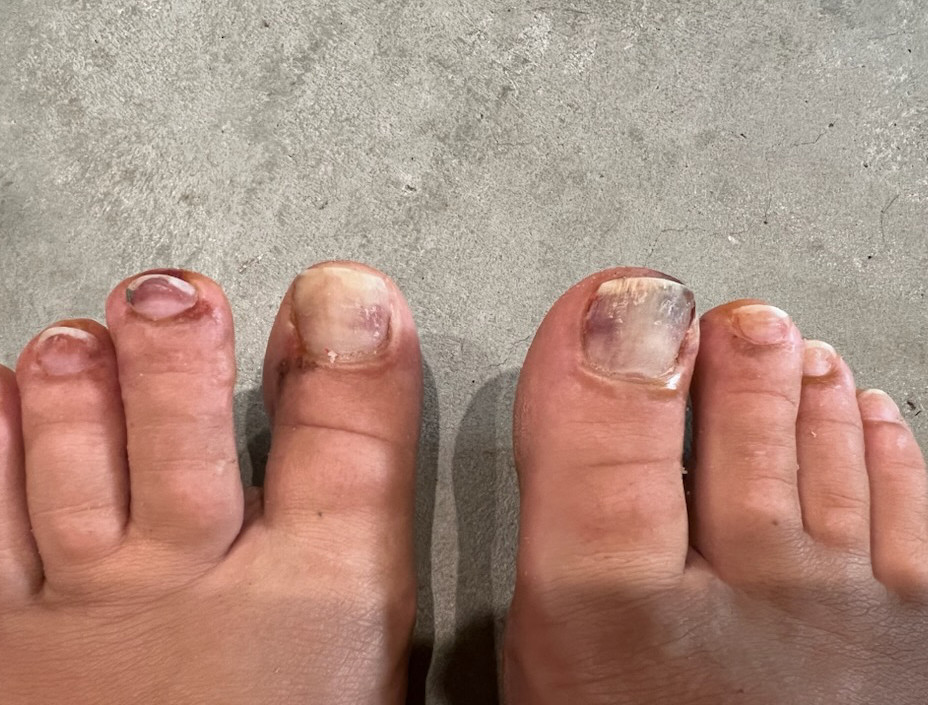 Update more than 130 effects of acetone on nails latest