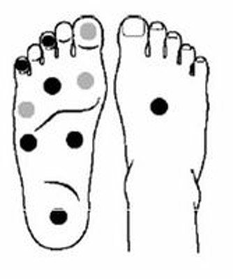 Using Monofilaments in Sensory Assessment Examinations for Diabetes 