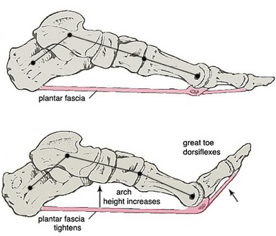 What is the Main Cause of Plantar Fasciitis