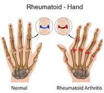 Adaptive Tools for Arthritis-Afflicted Hands