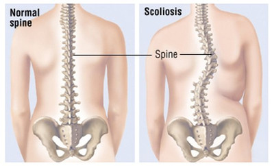 How to Treat Scoliosis Symptoms with Physical Therapy