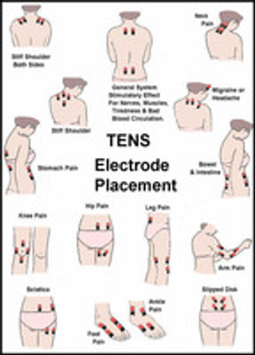 TENS Unit Electrode Placement Guide 