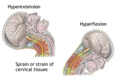 Treating Whiplash With Physical Therapy