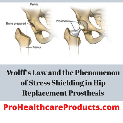 Wolff’s Law and the Phenomenon of Stress Shielding in Hip Replacement Prosthesis