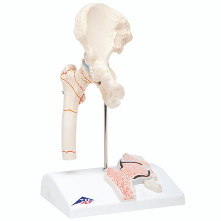 Anatomical Hip Model – Fractured Femur and Hip Osteoarthritis, 3B Smart Anatomy Anatomical Hip Model – Fractured Femur and Hip Osteoarthritis, 3B Smart Anatomy
