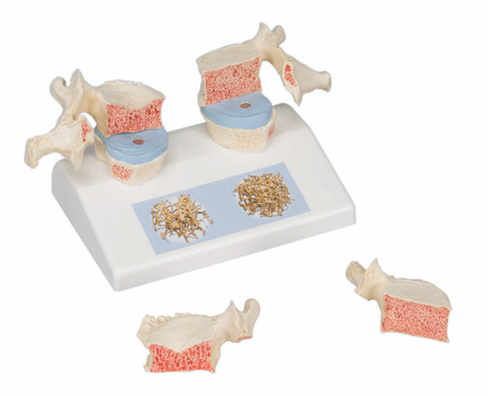 Vertebral Osteoporosis Model, 3B Smart Anatomy Included