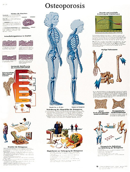 Anatomical Chart - effects of osteoporosis, paper