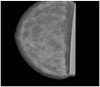Breast Phantom for Mammography and Breast Tomosynthesis