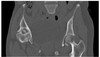 Pelvis Phantom with Coxarthrosis
