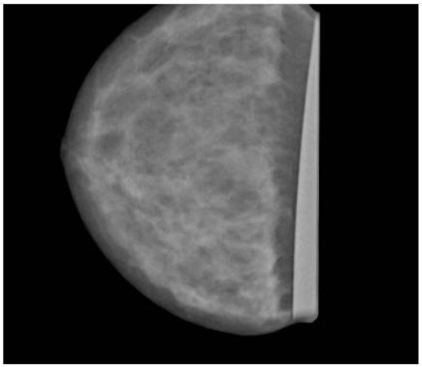 Breast Phantom for Mammography and Breast Tomosynthesis