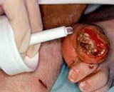 Hydrogel Dressing Intrasite 8 gm 66027308 Each/1 UNITED / SMITH & NEPHEW 272312_EA Hydrogel Dressing Intrasite 8 gm 66027308 Each/1 UNITED / SMITH & NEPHEW 272312_EA