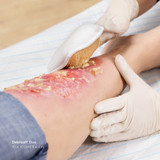 Debrisoft Debridement Agent Pad Sterile, 31222, Case of 50