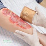 Debrisoft Debridement Agent Pad Sterile, 31222, Case of 50