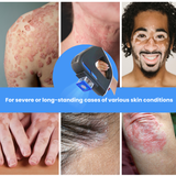 Kernel Excimer Laser 308nm Pro for Clinic Use – Intensity Calibration System Included