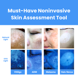 Wood’s Lamp, LED UVA Skin Analyzer with 2X Magnifying Lens & 3-Level White Light KN9000B