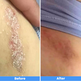 308nm Excimer Laser UVB Light Therapy – Highest Intensity and Precision UV Light for Severe Psoriasis and Vitiligo 