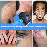 308nm Excimer Laser UVB Light Therapy – Highest Intensity and Precision UV Light for Severe Psoriasis and Vitiligo 