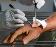 Types of Wound Preparation and When to Use Them