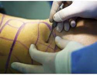 Surgical Skin Marker Purple Fine / Regular Tip NonSterile 1450XL-1000 Pack/100 SP592-000 Viscot Industries 986795_PK