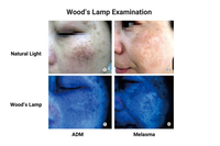 Wood’s Lamp, LED UVA Skin Analyzer with 2X Magnifying Lens & 3-Level White Light