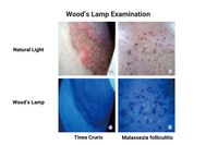 Wood’s Lamp, LED UVA Skin Analyzer with 2X Magnifying Lens & 3-Level White Light