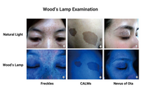 Wood’s Lamp, LED UVA Skin Analyzer with 2X Magnifying Lens & 3-Level White Light