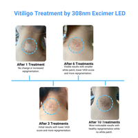 Handheld 308nm Excimer LED UVB Lamp – High Intensity, High Targeting Light Therapy for Vitiligo – Light Intensity 30 mw/cm²
