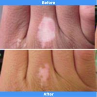 Handheld 308nm Excimer LED UVB Lamp – High Intensity, High Targeting Light Therapy for Vitiligo – Light Intensity 30 mw/cm²