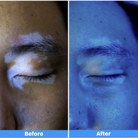 308nm Excimer Laser UVB Light Therapy – Highest Intensity and Precision UV Light for Severe Psoriasis and Vitiligo 