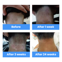 308nm Excimer Laser UVB Light Therapy – Highest Intensity and Precision UV Light for Severe Psoriasis and Vitiligo 