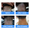 308nm Excimer Laser UVB Light Therapy – Highest Intensity and Precision UV Light for Severe Psoriasis and Vitiligo 