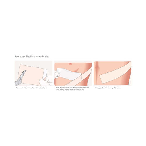Self Adherent Silicone Dressing Mepiform Silicone Gel 4 X 7 Inch 293499 Box/5 293499 MOLNLYCKE HEALTH CARE US LLC 712218_BX
