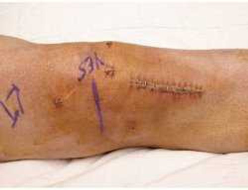 Surgical Skin Marker Purple Fine / Regular Tip NonSterile 1450XL-1000 Case/1000 503034 Viscot Industries 986795_CS Surgical Skin Marker Purple Fine / Regular Tip NonSterile 1450XL-1000 Case/1000 503034 Viscot Industries 986795_CS